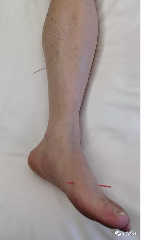 针灸治疗颈椎病视频全集,颈椎病针灸下针手法视频