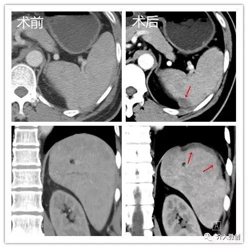 脾功能亢进导致血小板减少怎么办?