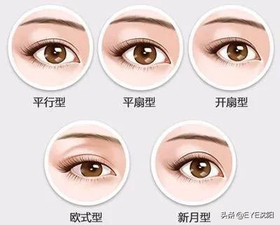 前窄后宽双眼皮是什么形状,方圆脸适合哪种双眼皮形状