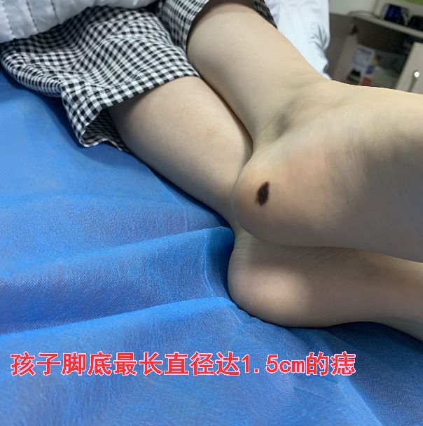 12岁女童身上的痣越长越大,小孩脚底有痣越长越大