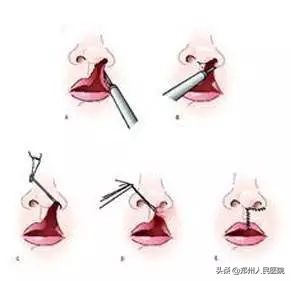 唇裂修复前后对比照,唇裂修复的全过程