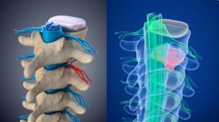 突出只是突出症的导火线，而不是根源，首先得弄懂患者是什么体质