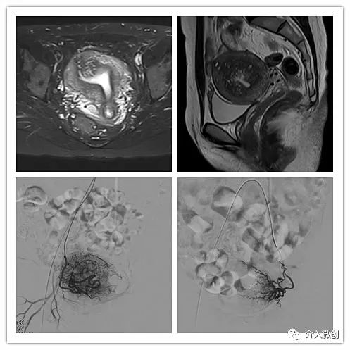 子宫腺肌病微创介入治疗时机