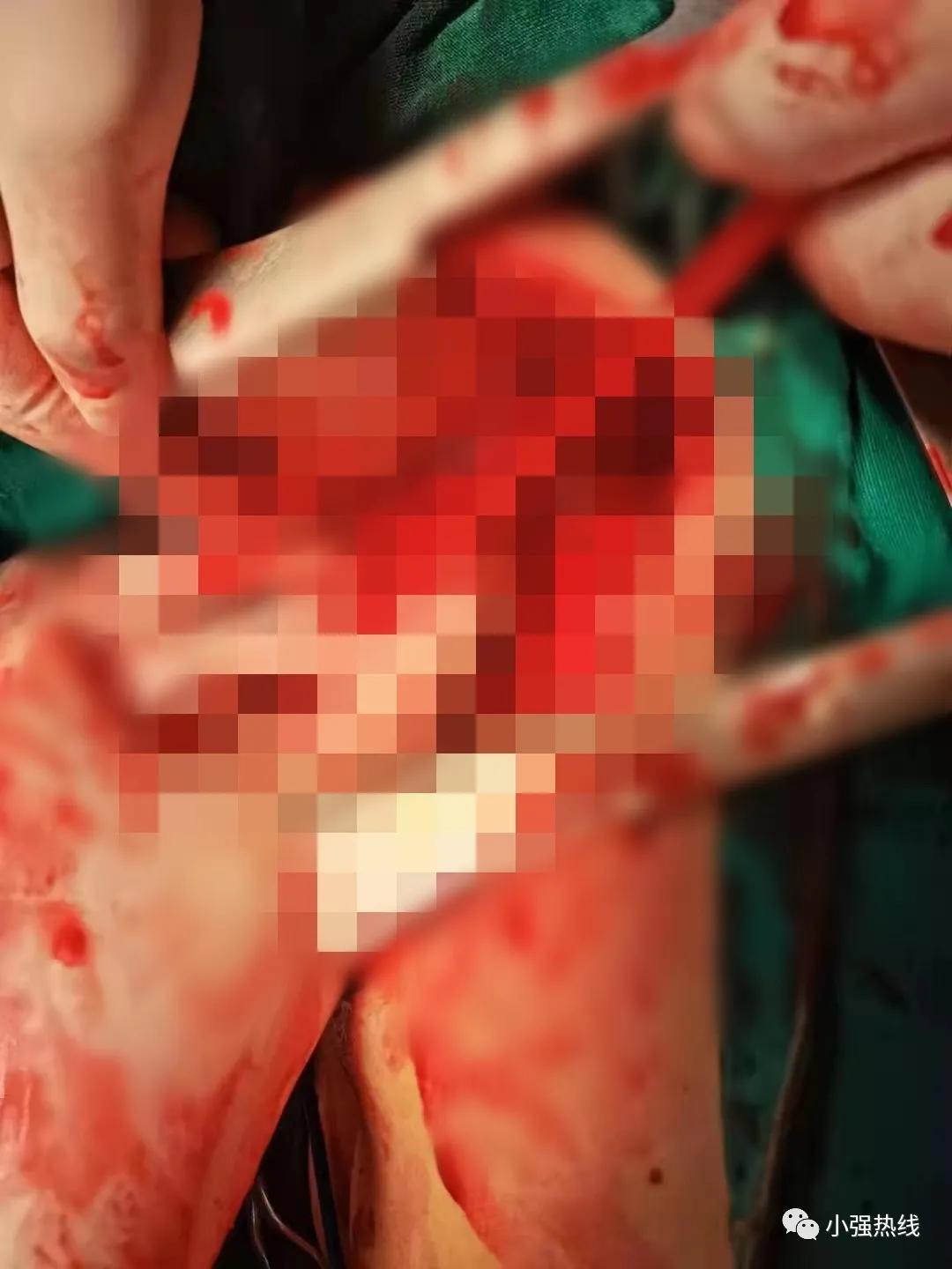 太狠了一剑刺穿心爱的人,小伙胸口被刀捅人事件