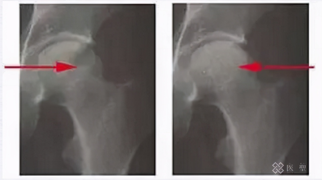 干细胞回输能治疗股骨头坏死吗,造血干细胞治疗股骨头坏死