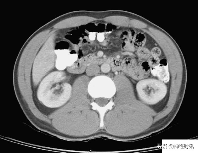肾脏输尿管膀胱前列腺结构,肾输尿管膀胱解剖示意图