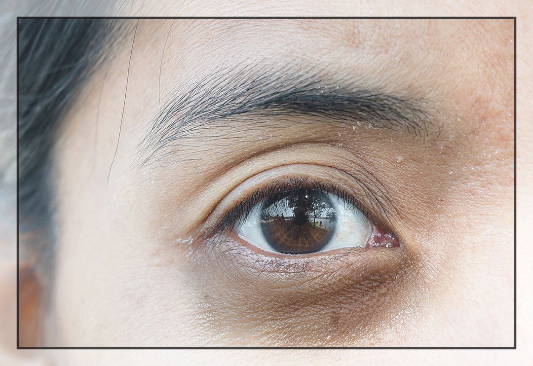 董氏奇穴一针治疗黑眼圈,熊猫针一针就能去掉黑眼圈吗