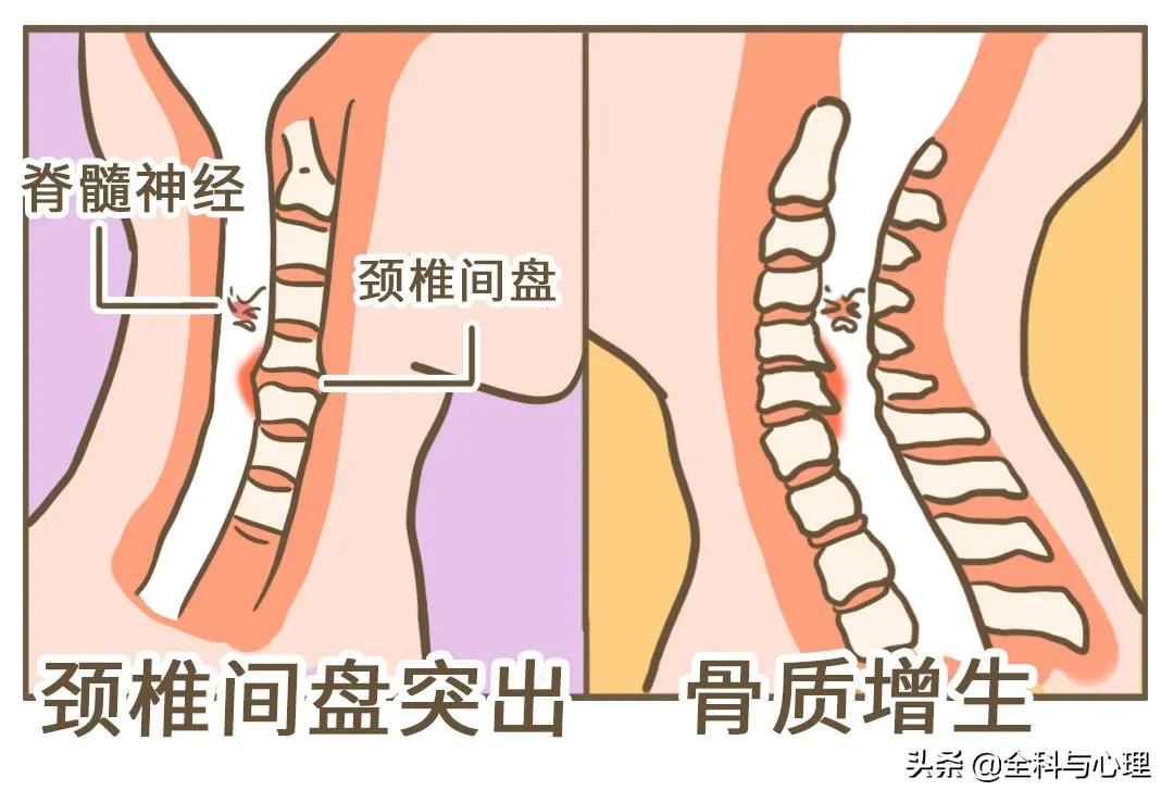 落枕可能是颈椎在喊救命,脖子落枕治疗的方法