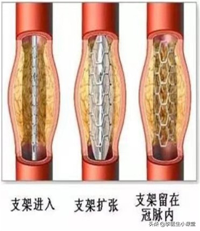 48岁心肌梗死不支架可以吗,35岁得心梗没放支架恢复很好