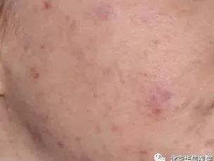 光子嫩肤唤醒肌肤活力重塑娇颜,光子嫩肤让你焕颜一新