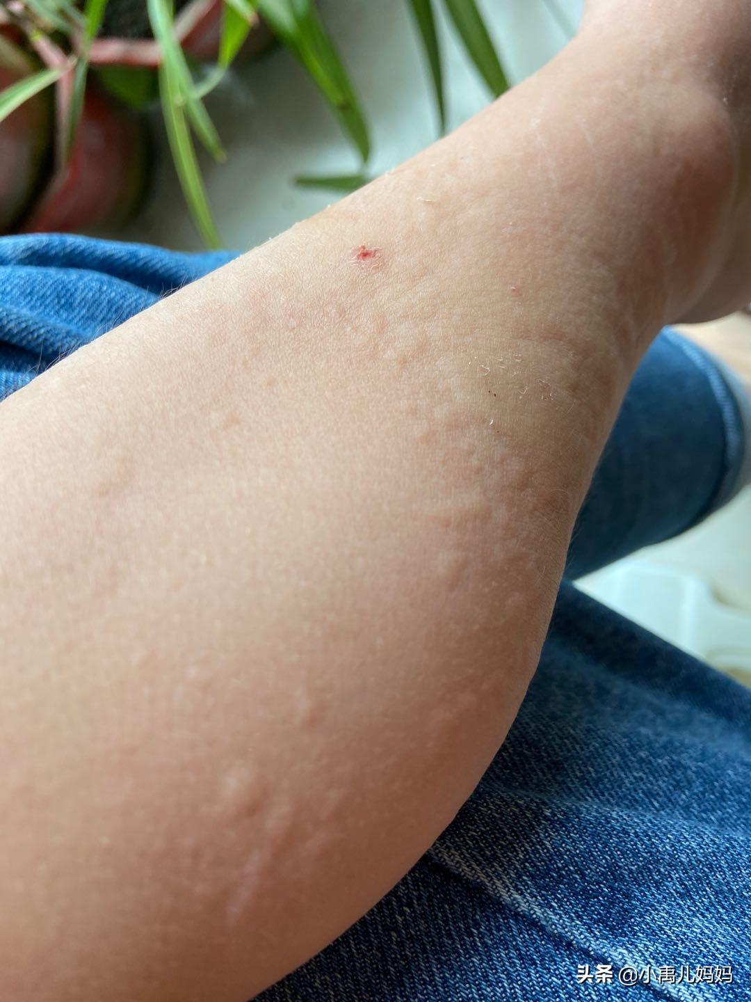 牛奶鸡蛋小麦过敏要注意什么,牛奶蛋白过敏宝宝可以吃什么辅食