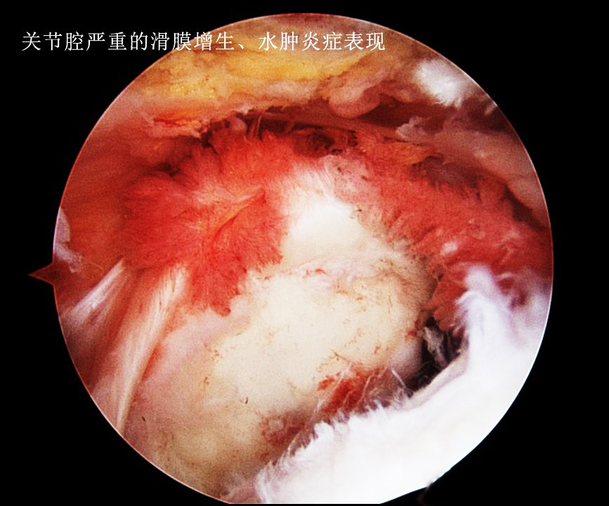 膝盖积水以后是热敷还是冷敷？真能解决问题吗？医生：可能都没用