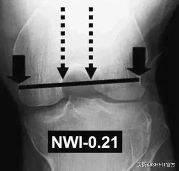 女性膝关节疼痛的最好治疗方法,为什么女性膝关节更容易出问题