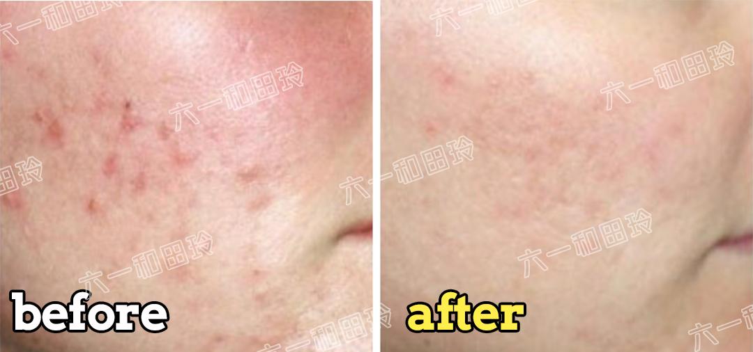 医美刷酸后爆痘期要多久,痘痘肌医美刷酸能好吗