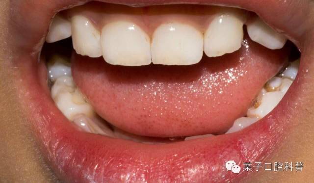 一般的刷牙方法能清除牙菌斑,小朋友牙齿有牙菌斑要洗掉吗