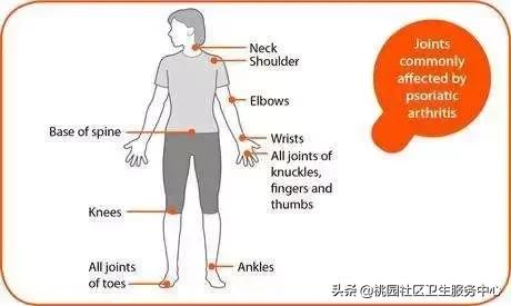 得了银屑病必须要知道的事,银屑病生活中要注意这8点