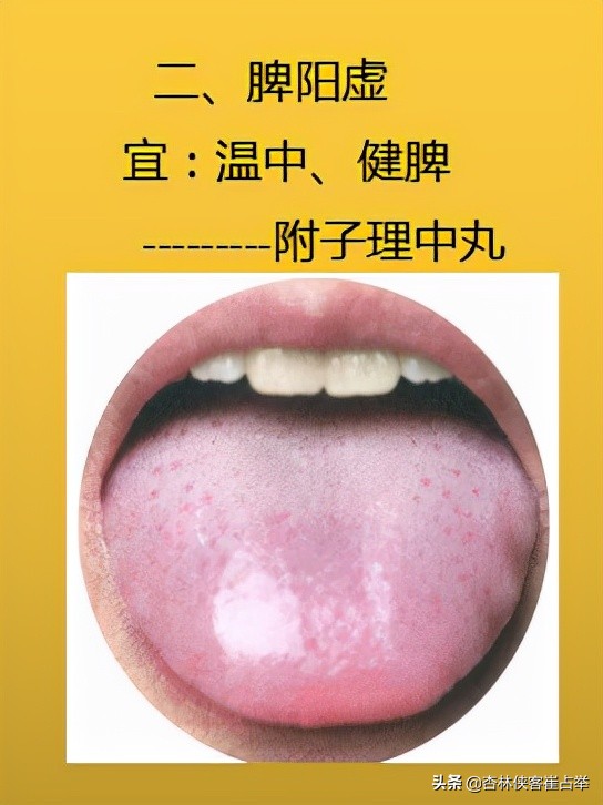 生理性齿痕舌与病理性齿痕舌,齿痕舌形成的原因是脾虚还是瘀血