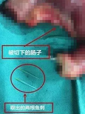 卡鱼刺在喉咙吃醋有用吗,吃鱼刺卡到的急救方法