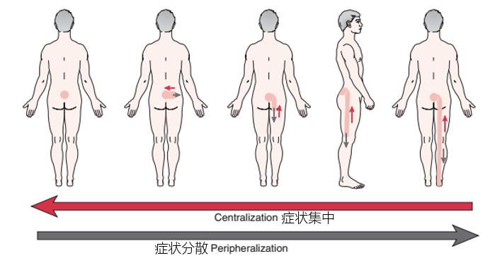 腰突压迫神经腿麻与疼哪个严重,腰突腿麻疼痛最快的解决方法