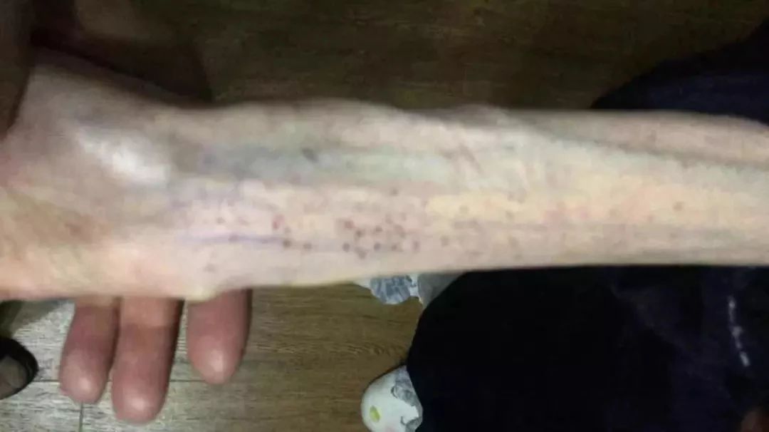 肥胖是如何摧残你的身体的,病态减肥的后果