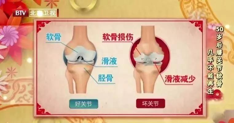 骨刺没有症状需要消除吗,骨刺用什么方法能消掉