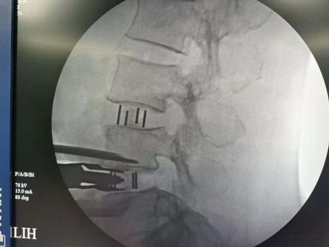 腰椎管狭窄有滑脱能做微创吗,腰椎滑脱椎管狭窄可做微创吗