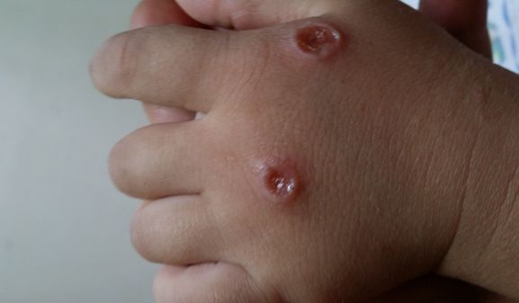 水痘疱疹丘疹一起出现,季节交替带状疱疹进入高发期