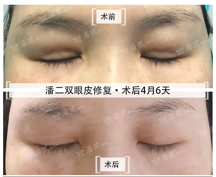 眼皮填充的脂肪凹凸不平怎么办,上眼皮凹陷填充脂肪有危险吗