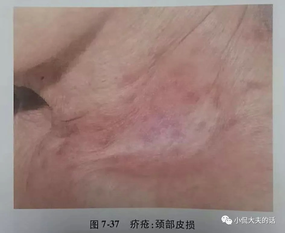 得了疥疮可以吃猪肉吗,大猪身上长癣怎么治用什么药