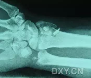 几种严重骨折医学名称,常见的骨折有哪些名称