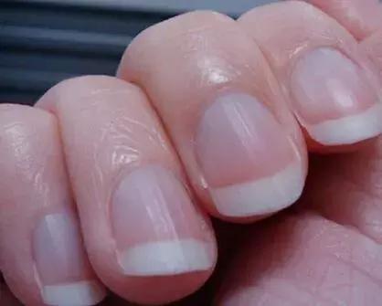 大拇指指甲有竖纹跟凹陷怎么回事,大拇指甲上有白色竖纹是怎么回事