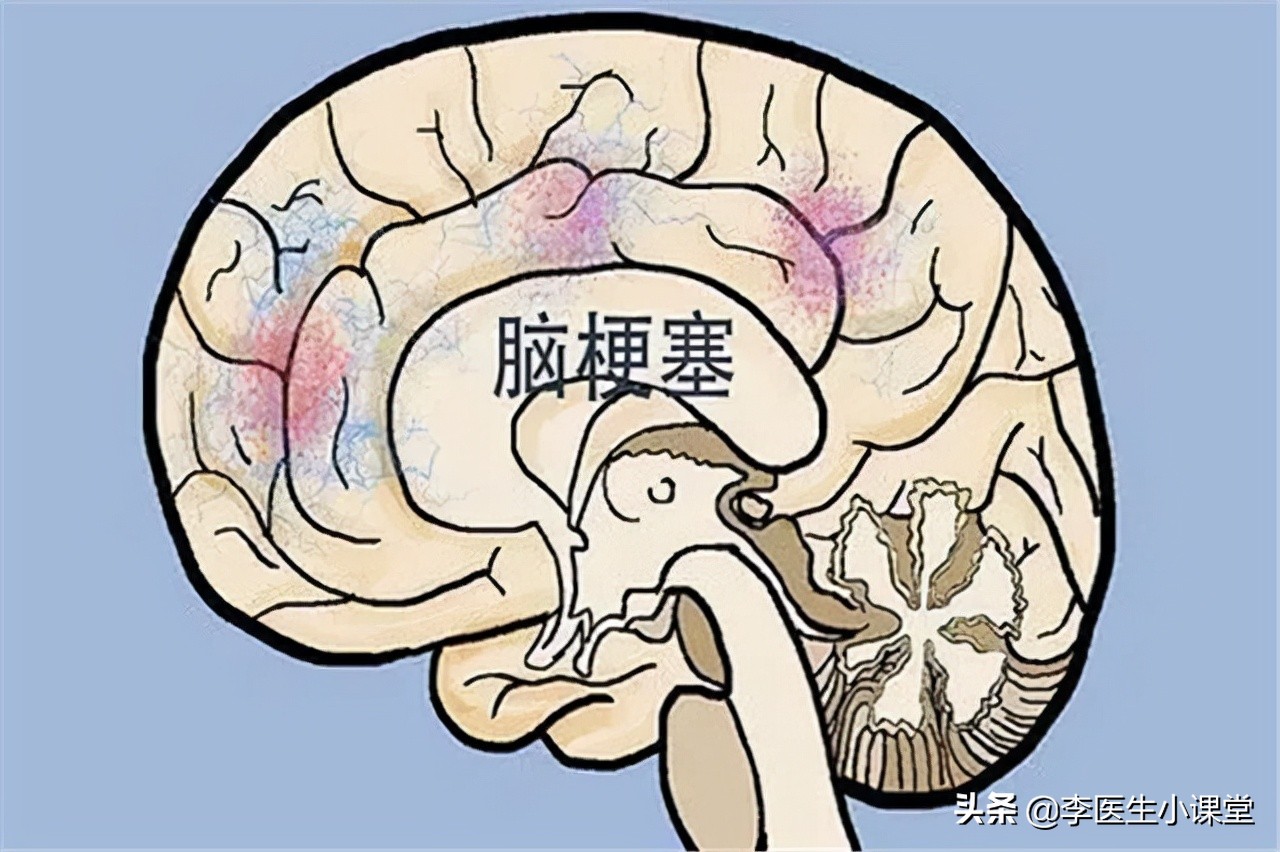 老年人预防脑梗可以长期吃叶酸吗,预防脑梗怎么补充叶酸和维生素b12