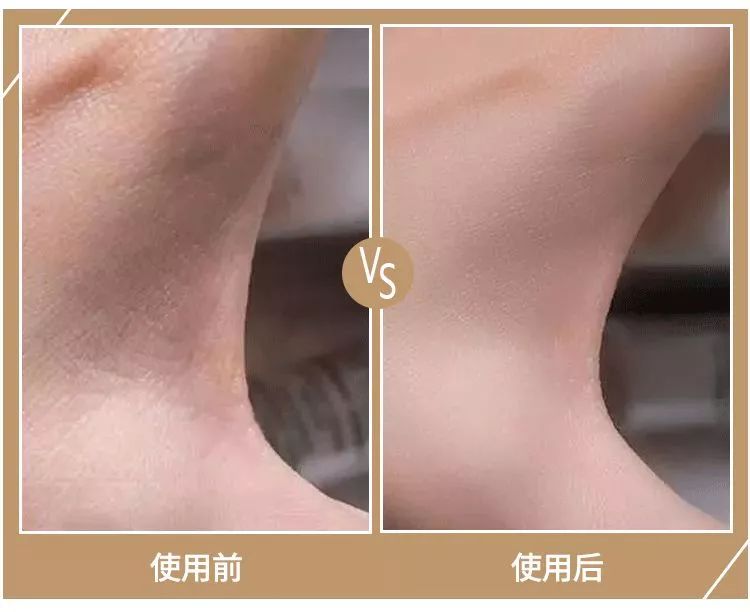 秋冬手干裂擦手霜,冬天手脚干裂涂什么护肤品