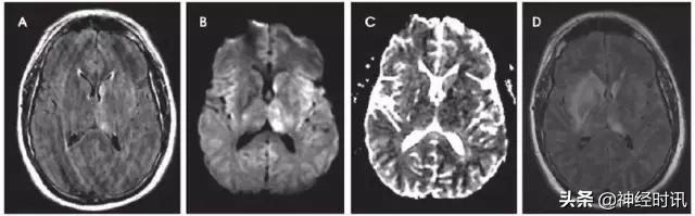 脑卒中病历诊断书图片,脑卒中影像判断技巧图解电子版