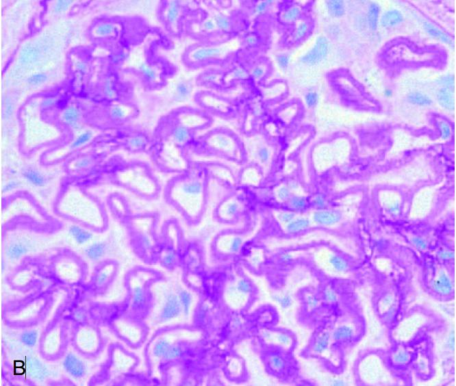 系统性红斑狼疮性肾炎的诊断方法 (狼疮性肾炎和系统性红斑狼疮区别)