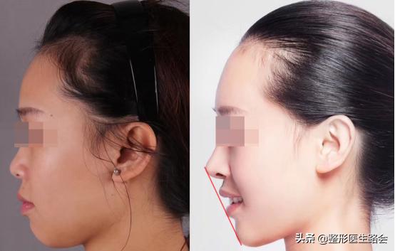 鐗欓娇澶栧嚫涓嬪反鍚庣缉鎬庝箞鐭,涓颁笅宸村彲浠ユ敼鍠勭墮榻垮悗缂╁悧