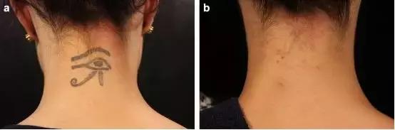 纹身的激光治疗,激光能祛纹身吗