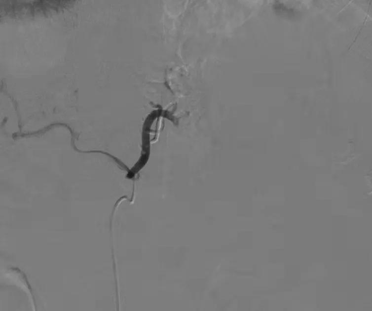 生命不能承受之重完整版视频,胃左动脉栓塞减肥手术后遗症