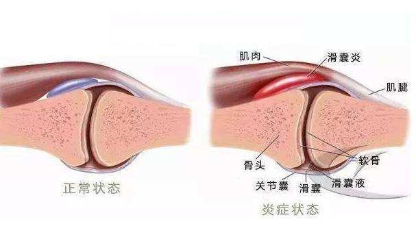 痛风石怎么溶解排出能痊愈,痛风石破溃后能自行愈合吗