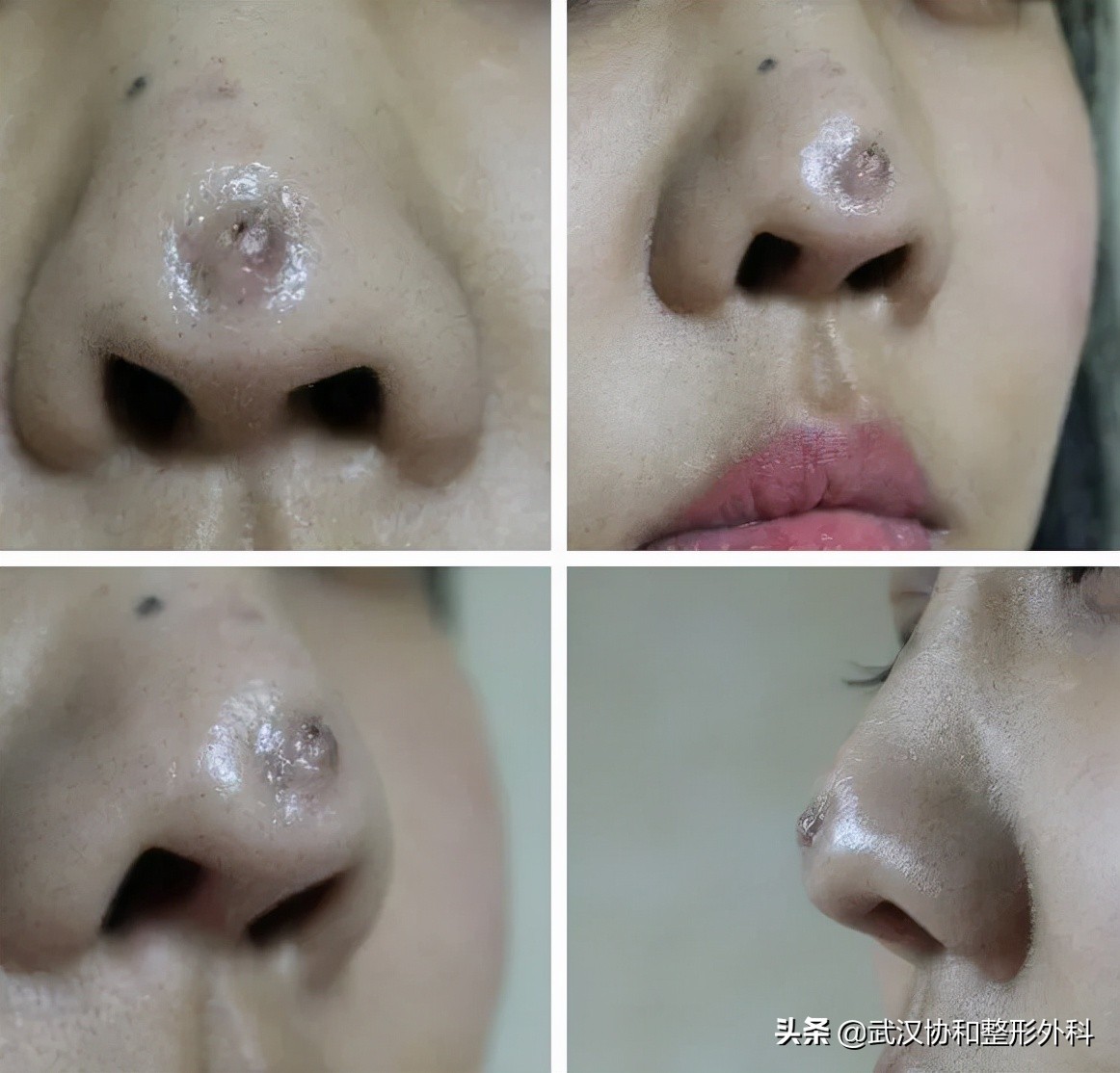 线雕隆鼻的副作用和危害,线雕隆鼻费用一般多少钱