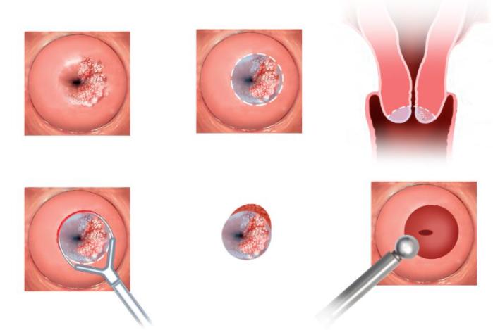 请收藏，迄今最全面的宫颈癌疫苗问答，都在这了