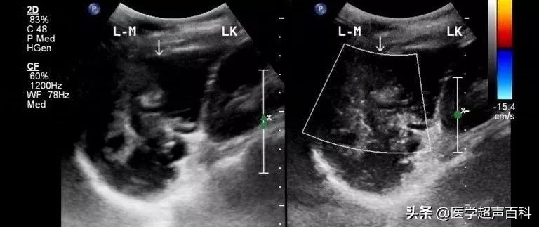 阑尾粘液性肿瘤低度恶性怎么处理,恶性阑尾黏液肿瘤是癌症吗