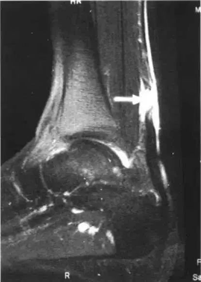 杜兰特对猛龙跟腱受伤视频,伤病猛于虎下一句