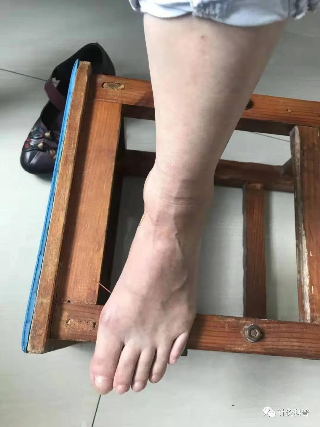 民间中医针灸治疗疑难杂症,中医疑难杂症针灸治疗成功