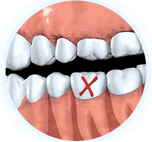 德州种牙的口腔医院哪家好,nobel种植牙医院