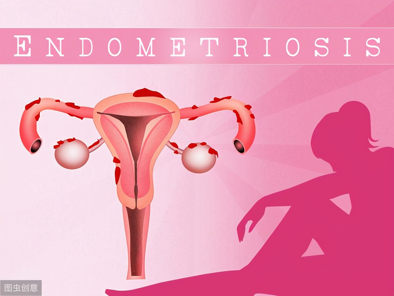 巧克力囊肿适合哪种试管方案,试管巧克力囊肿需要做宫腔镜吗