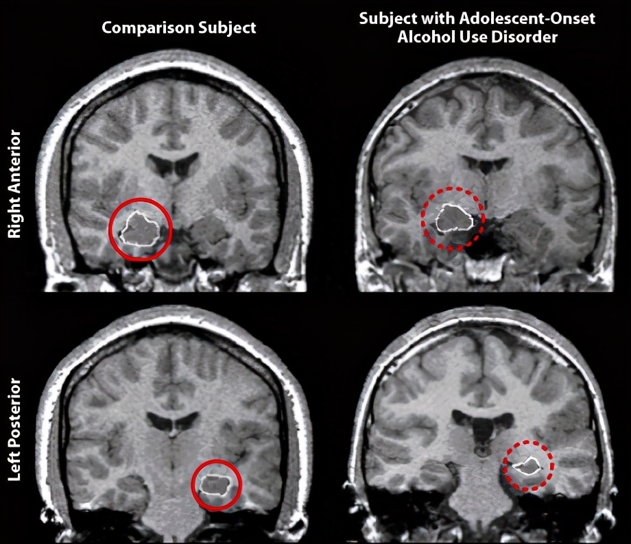 酒精主要影响大脑的哪个部分,酒精对大脑造成的第一个反应