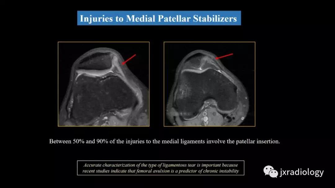 髌股关节失常磁共振看什么,髌股关节混乱的影像评估