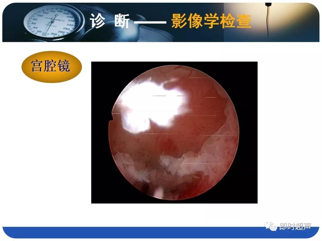 孕妇剖宫产瘢痕憩室,剖宫产瘢痕憩室息肉