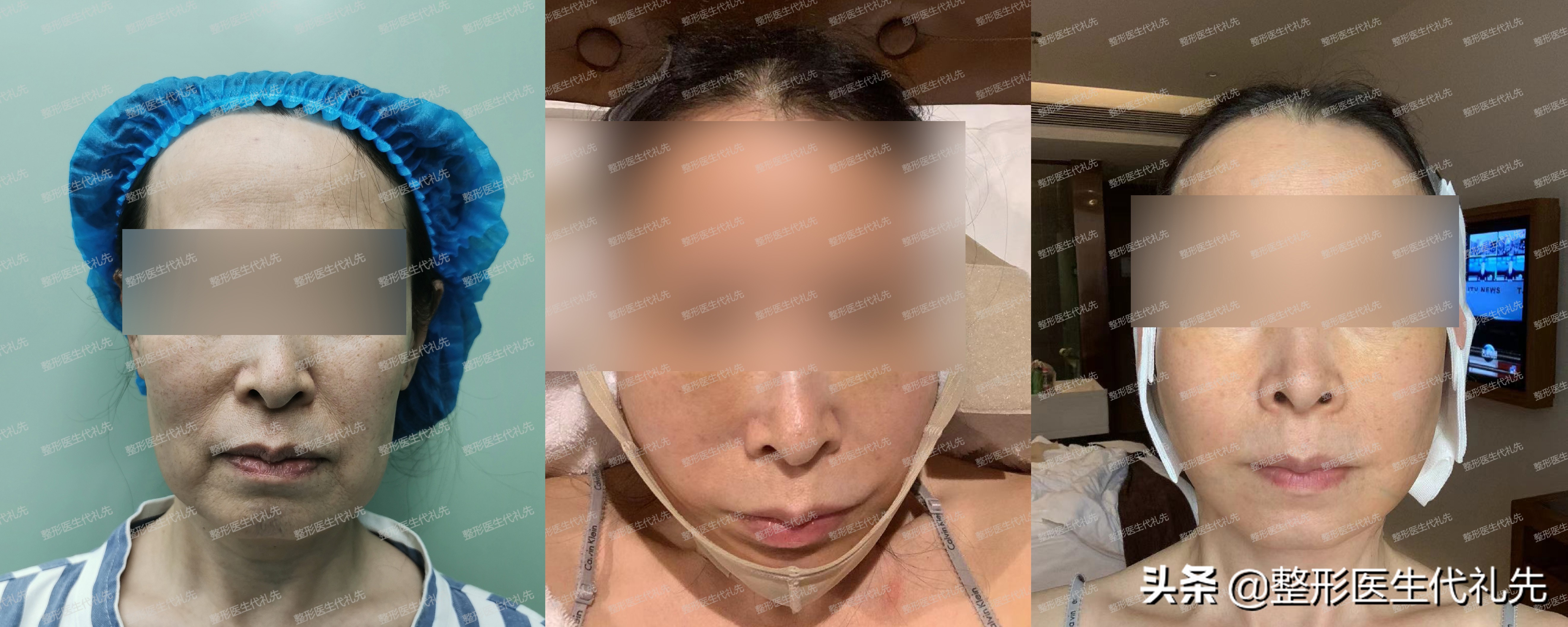 减肥后拉皮后的皮肤会松弛吗,减肥后皮肤松弛下垂怎么办图片